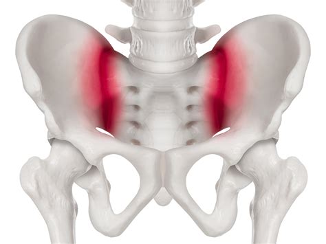 Sacroiliac Joint Dysfunction 